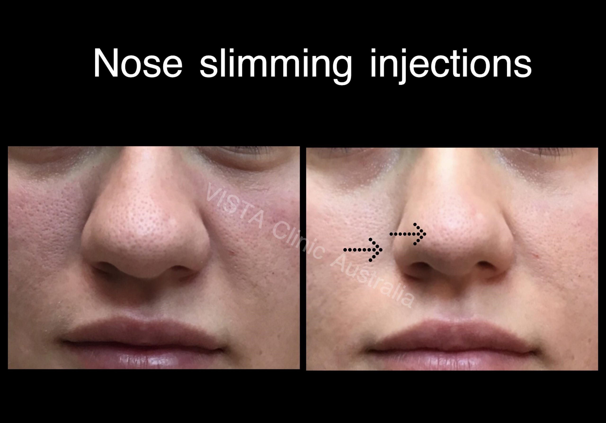 rhinoplasty surgery