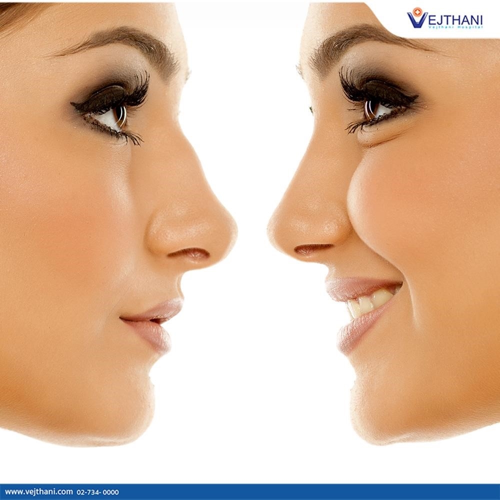 rhinoplasty surgery