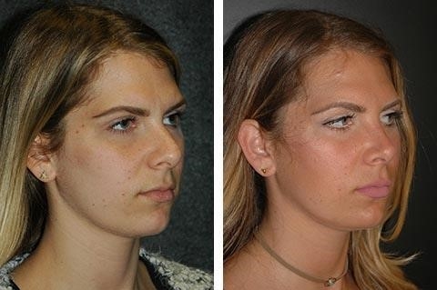 rhinoplasty surgery