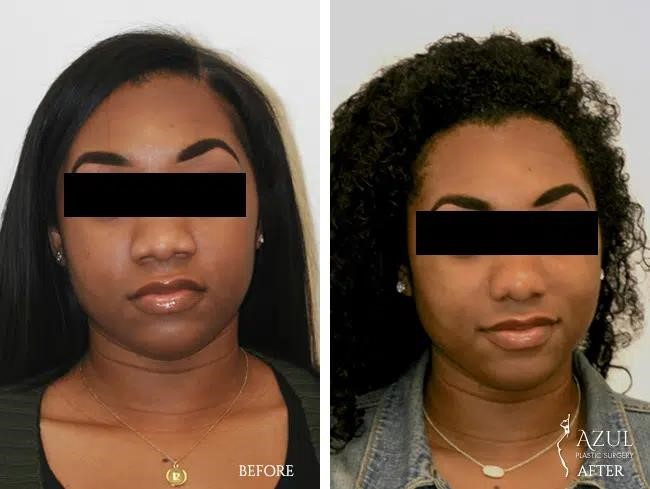 rhinoplasty surgery